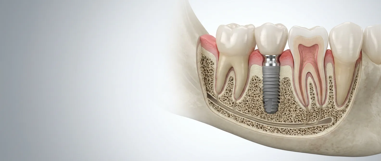 Implant dentar la Cheo Klinik