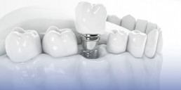 Implantologie dentara Cheo Klinik, clinica stomatologica copii si adulti
